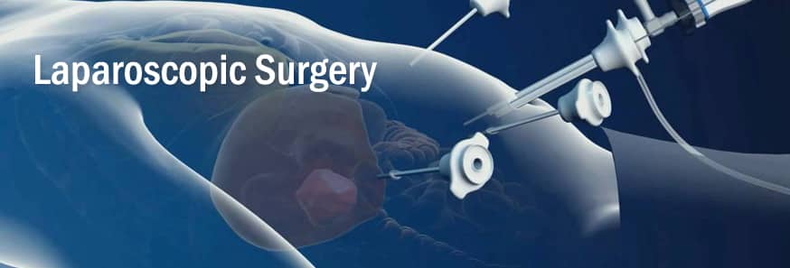 Laparoscopic Surgery Hyderabad