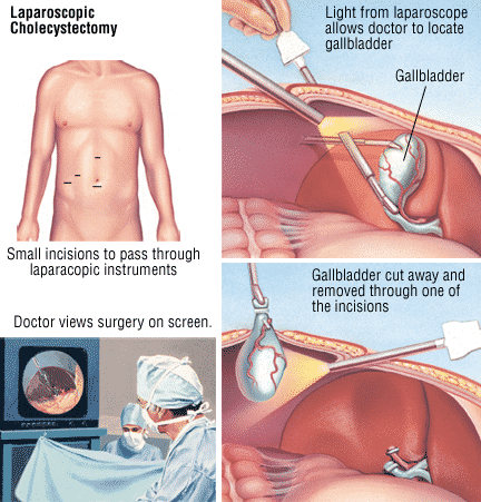 Is Surgery Require for Every Cholelithiasis Patient3
