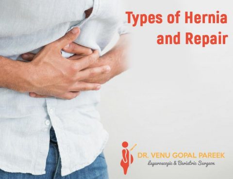 Types of Hernia and Repair