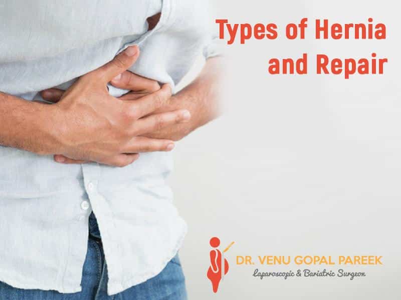 Types of Hernia and Repair