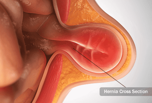 Types of Hernia and Repair1