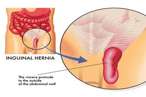 Types of Hernia and Repair2