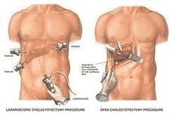 Gallstones - Surgical Treatment vs Medical Treatment
