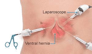 Ventral Hernia -Laparoscopy Vs. Open Repair Which Is Better?