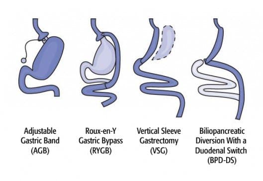 stomach-pump-surgery-aspire-bariatrics
