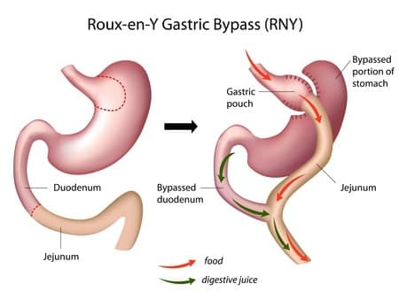 A Guide To Different Types of Bariatric Surgeries Performed
