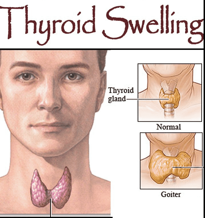 Thyroid Swelling Investigation And Treatment