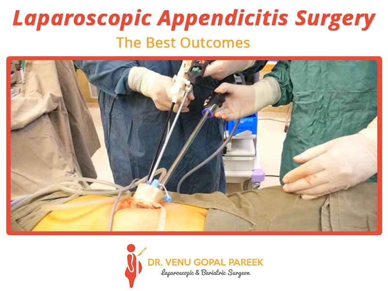 laparoscopic-apendisitis_drvpareek