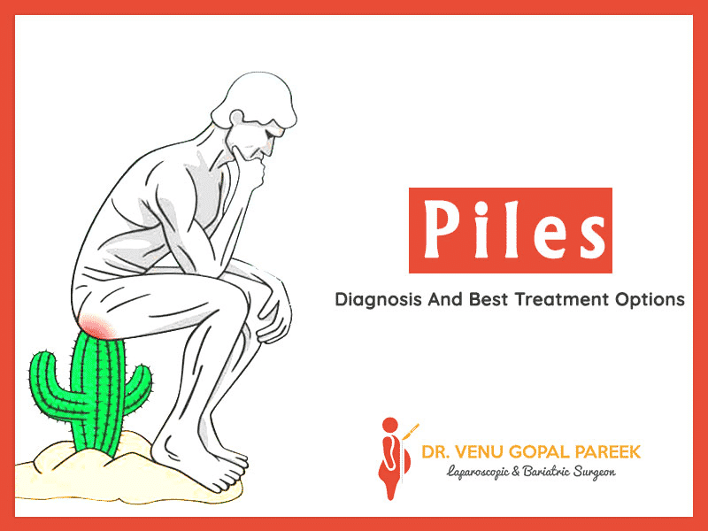 Piles- Diagnosis And Best Treatment Options