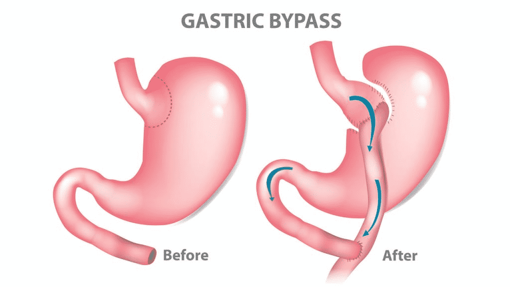 Bariatric Surgery-Final Frontier When Other Weight Loss Option Fails