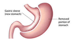 Laparoscopic Sleeve Gastrectomy-Procedure And Outcomes