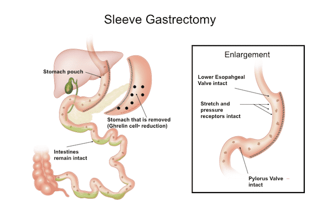 Laparoscopic Sleeve Gastrectomy-Procedure And Outcomes