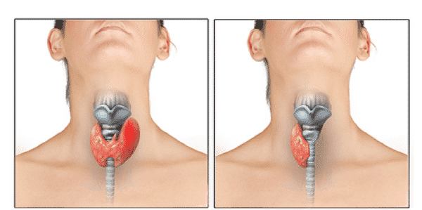 Surgical Treatment For Thyroid Disorder