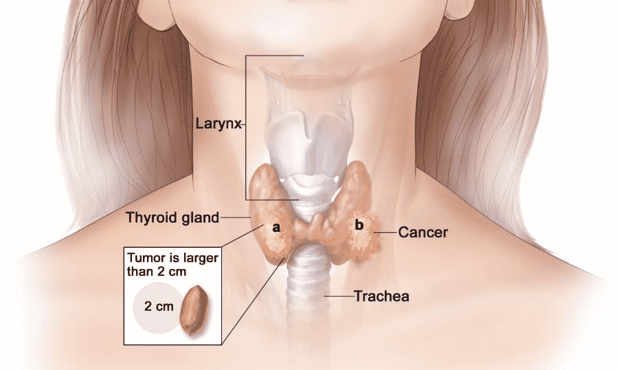 Surgical Treatment For Thyroid Disorder