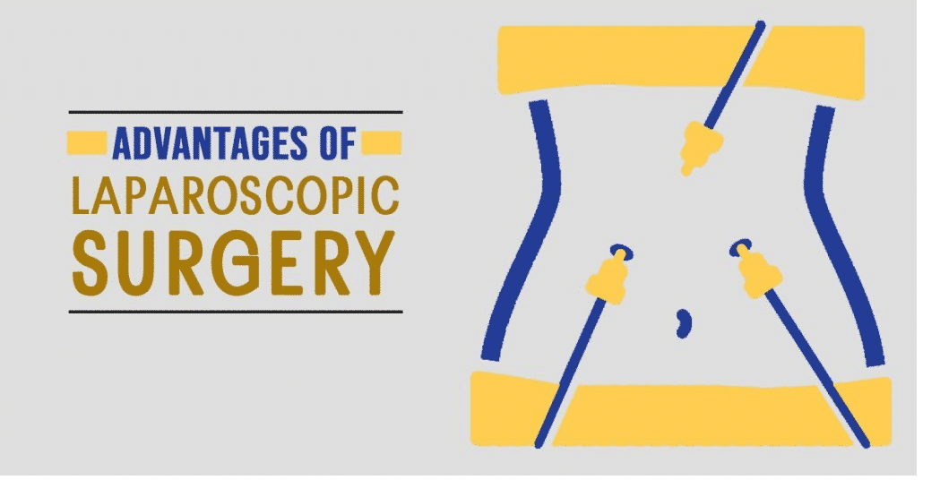 Laparoscopic Gastric Bypass Surgery: Frequently Asked Questions