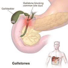 Gallstones Diagnosis, Symptoms And Treatment