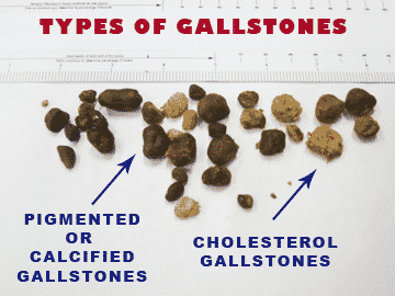 Gallstones Diagnosis, Symptoms And Treatment