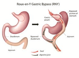 Laparoscopic Gastric Bypass Surgery: Frequently Asked Questions