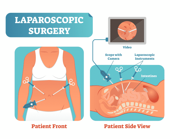 travel by car after laparoscopic surgery