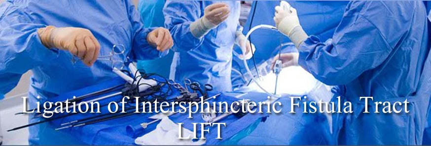 Treat or repair your Fistula in Ano with Ligation of Intersphincteric Fistula Tract, Best Anal Fistula Surgery in Hyderabad  