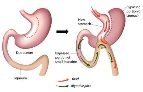 Mini Gastric Bypass Surgery in Hyderabad helps you reduce obesity safely