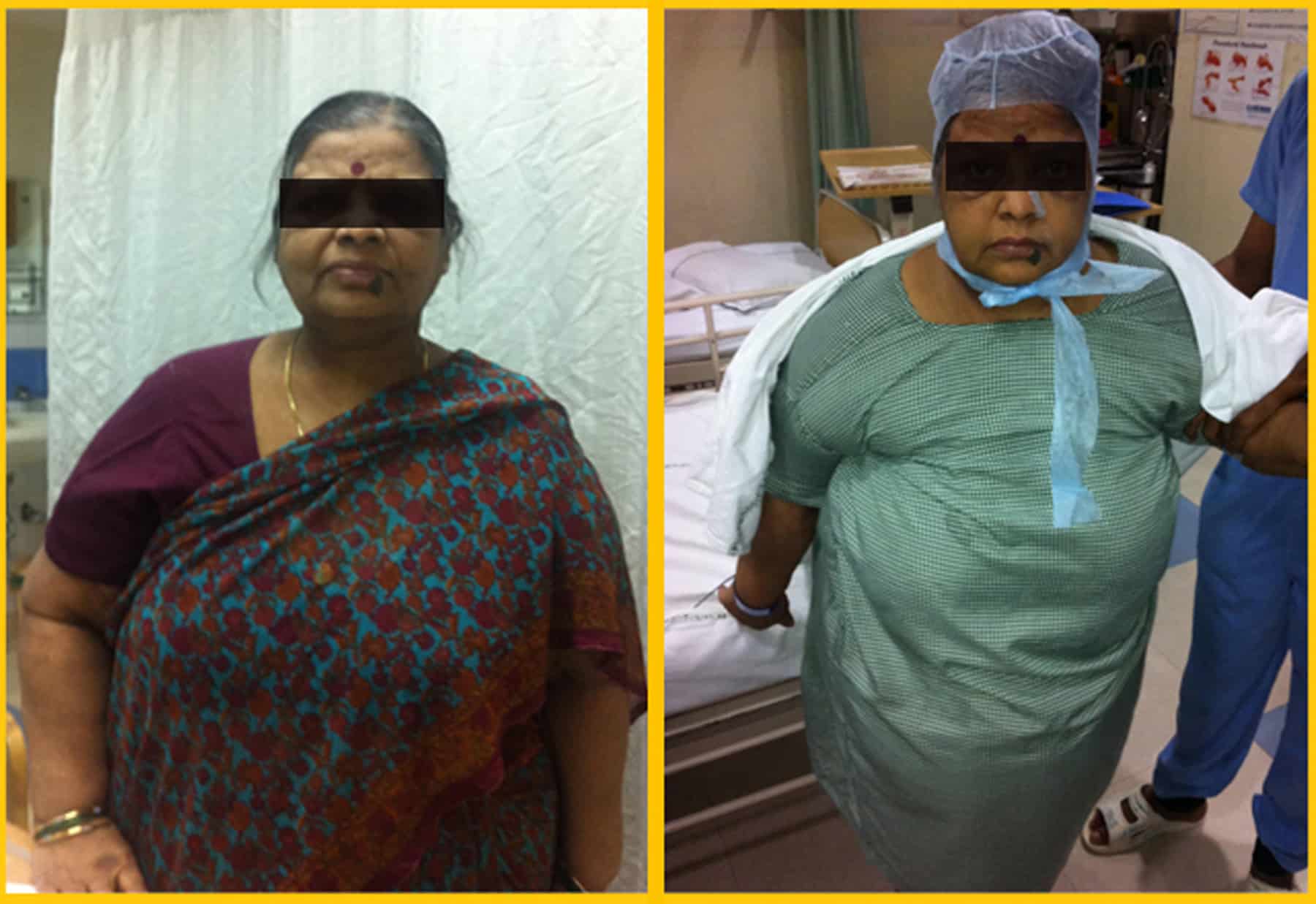 Bariatric surgery results - Weight loss reduction pictures