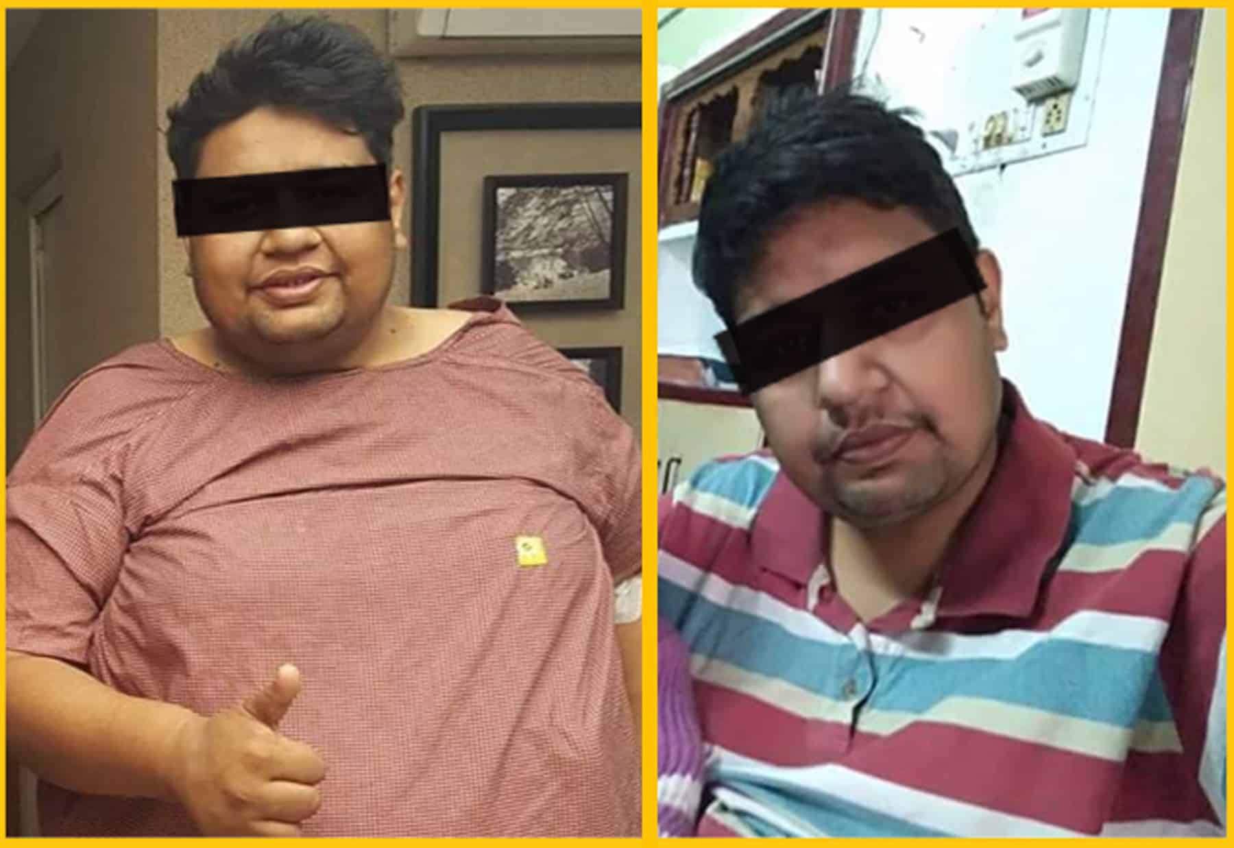 Weight loss reduction results after Bariatric surgery in Hyderabad