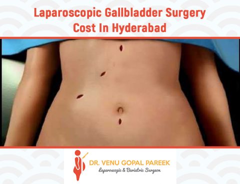 Gallbladder stones surgery cost in hyderabad