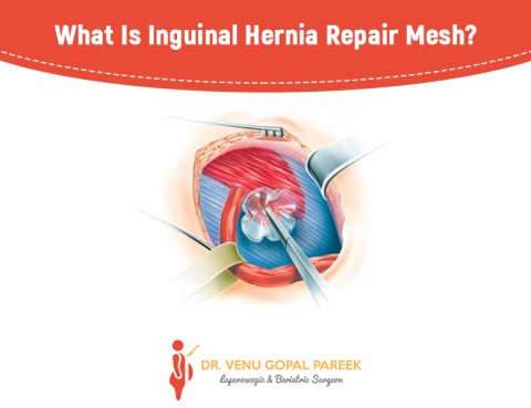 Get today Inguinal hernia repair by Dr Venugopal Pareek, One of the Best Laparoscopic surgeon near me
