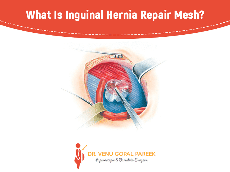 Get today Inguinal hernia repair by Dr Venugopal Pareek, One of the Best Laparoscopic surgeon near me