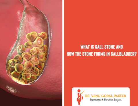 Get today Gallstone Removal Surgery by Dr Venugopal Pareek, One of the Best Laparoscopic and Bariatric surgeon in Hyderabad