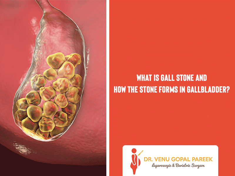 Get today Gallstone Removal Surgery by Dr Venugopal Pareek, One of the Best Laparoscopic and Bariatric surgeon in Hyderabad