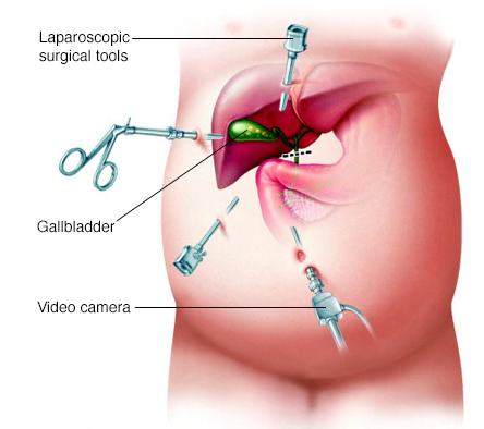 Best Laparoscopic gallbladder operation by Dr Venugopal Pareek, One of the Best Laparoscopic surgery doctor in Hyderabad