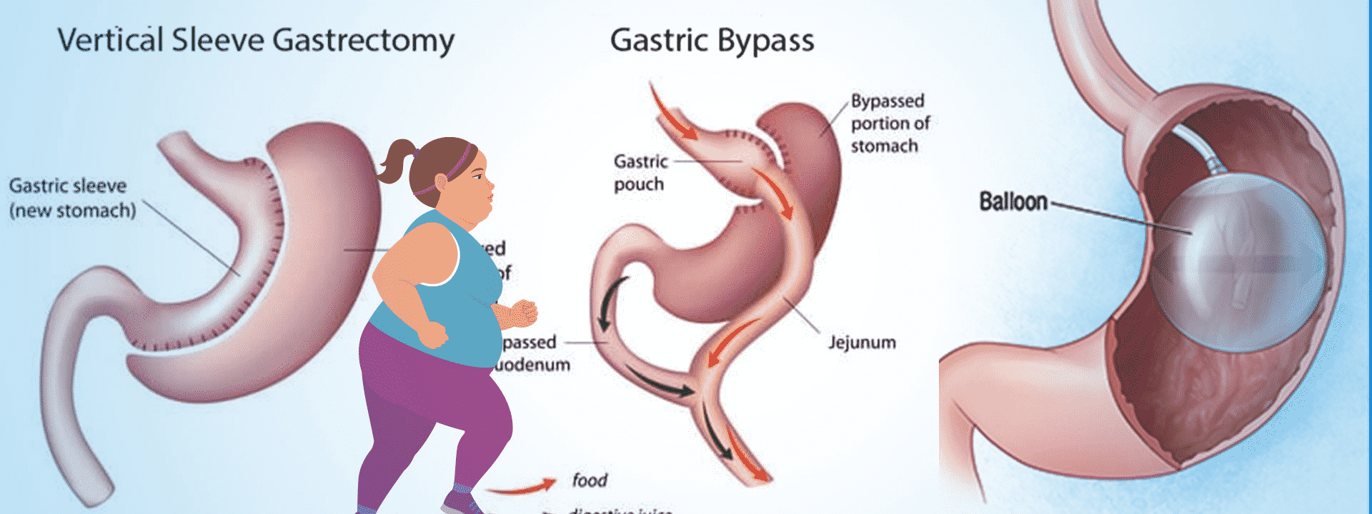 Vertical Sleeve Gastrectomy and Gastric Bypass surgery by Dr Venugopal Pareek, Best Bariatric surgeon in Hyderabad