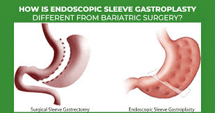 Best Endoscopic Sleeve gastroplasty surgery by Dr Venugopal Pareek, Best Laparoscopic and Bariatric sugeron in Hyderabad