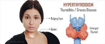 Get today Hypothyroidism treatment by Dr Venugopal Pareek, Best Thyroid surgeon in Hyderabad