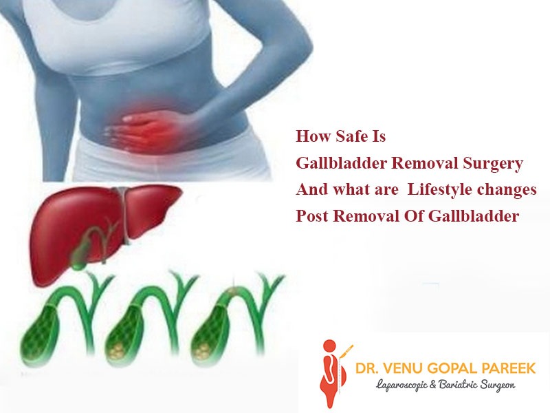 Get today Gallbladder removal surgery by Dr Venugopal Pareek, best Bariatric surgeon in hyderabad