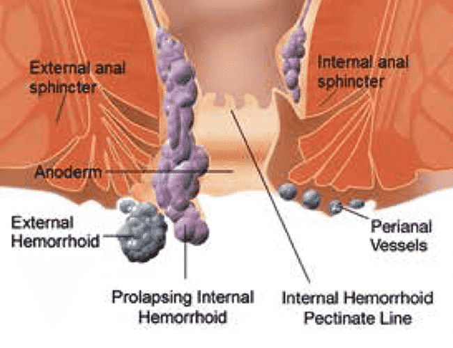 External and Internal Haemorrhoids surgery by Dr Venugopal Pareek, One of the Best Bariatric clinic in Hyderabad