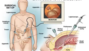 Gallbladder Removal surgery procedure by Dr Venugopal Pareek, Bariatric and Laparoscopic specialist in Hyderabad
