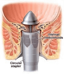 Get today Minimally invasive surgery for piles by Dr Venugopal Pareek, Piles Doctor in Hyderabad