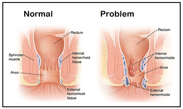 Best Inside external haemorrhoids surgery by Dr Venugopal Pareek, One of the best Piles specialist doctor in Hyderabad