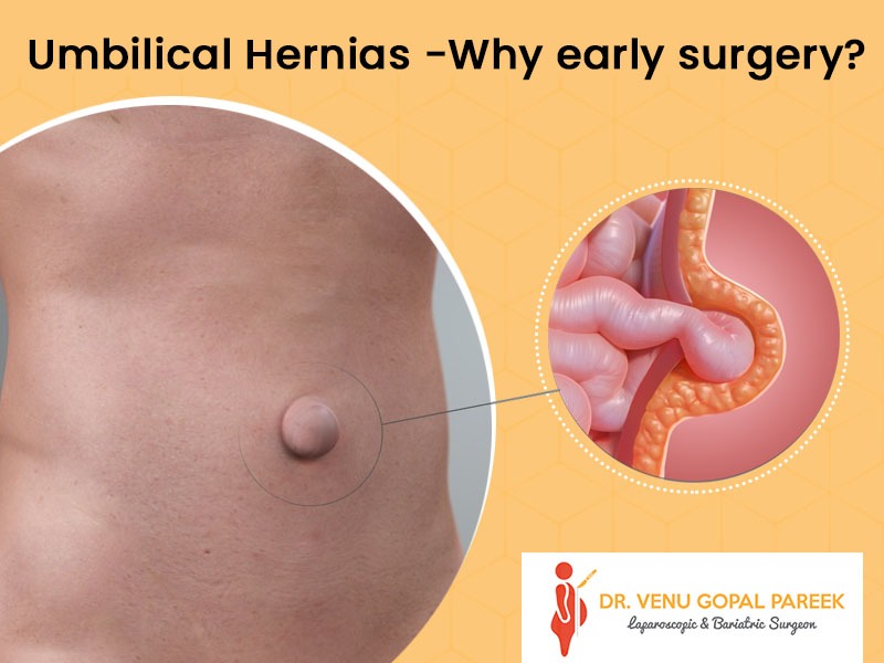 Consult Dr Venugopal Pareek, Laparoscopic surgeon in hyderabad for Best umbilical hernia surgery in hyderabad