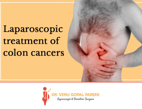 Best treatment for Laparoscopic Colon Cancers in Hyderabad, laparoscopic gallbladder surgery specialist near me