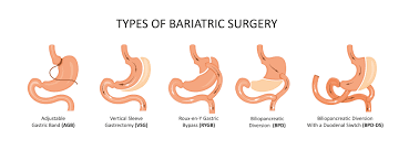 All types of Bariatric surgeries by Dr. Venugopal Pareek, One of the best Complexion hernia surgeons near me