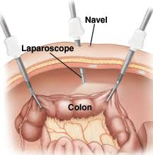 Best Laparoscopic surgery for colon cancer in Hyderabad, the best hospital for appendix surgery near me