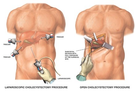 Contact with Dr. Venugopal Pareek to find the best One from open cholecystectomy vs laparoscopic cholecystectomy, Gallbladder stone removal surgery centre near me