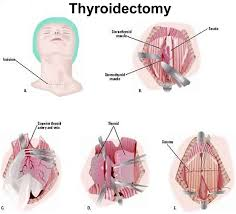 The best treatment for Thyroidectomy at Dr. V Pareek Clinic, One of the best hospitals for Thyroid disorder surgeries in Hyderabad