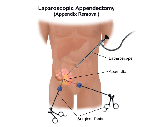 Best Laparoscopic Appendix removal surgery in Hyderabad, appendix surgery clinic near me