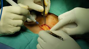 Best Thyroid Removal Surgery in Hyderabad, hypothyroidism doctors near me
