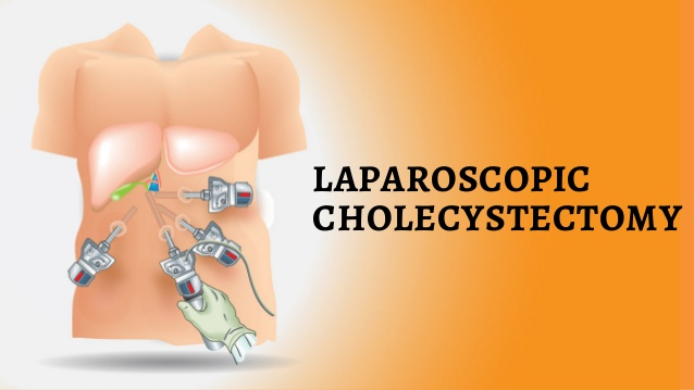 Best Laparoscopic Minimally invasive cholecystectomy by Dr. Venugopal Pareek, One of the best Bariatric and Laparoscopic surgery doctors in Hyderabad